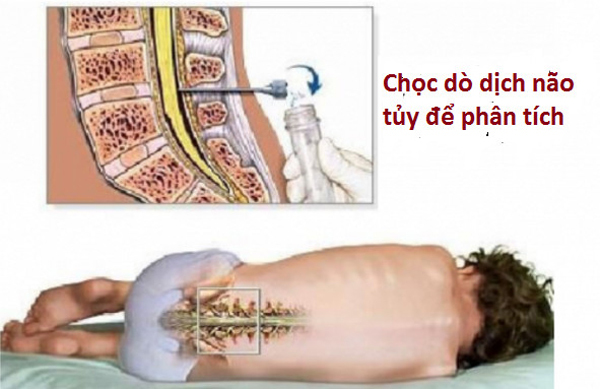 cách nhận biết sớm trẻ bị viêm não